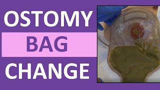 Ostomy Bag Pouch Change  Ostomy Care Nursing  Colostomy Ileostomy Bag Change [upl. by Erdnaet]