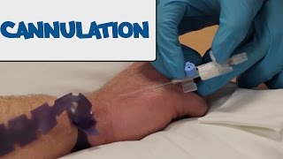 How to Perform Cannulation  OSCE Guide old version  UKMLA  CPSA [upl. by Nilerual]