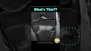 Fig 4B25 Ogden Type IV Tibial Tuberosity Fracture [upl. by Yelich]