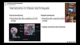 03 variations in the maxillary local infiltration techniques [upl. by Silyhp]