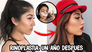 Rinoplastia COSTOS ASIMETRIA INFLAMACION TODA MI EXPERIENCIA [upl. by Kenton]