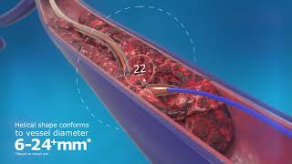 ClotHunter™ paired with ZelanteDVT™ Thrombectomy Catheter Enhancement [upl. by Lacram834]