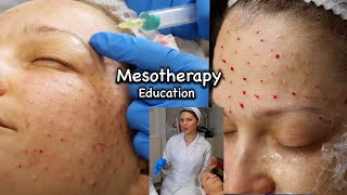 Mesotherapy for Face including around the Eyes injection technique using 13mm 30G needle [upl. by Fassold716]