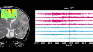 Neuroimagerie fonctionnelle par ultrasons chez le nouveauné [upl. by Aydiv]