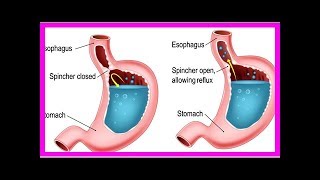 Barrett’s Esophagus [upl. by Velleman]