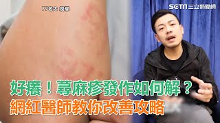 好癢！蕁麻疹發作如何解？網紅醫師教你改善攻略｜三立新聞網SETNcom [upl. by Tirrag]