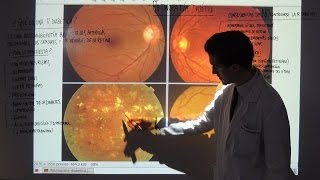 Retinopatía Diabética  Tipos y Tratamiento  Patología Ocular [upl. by Aryahay]