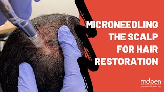 Microneedling The Scalp For Hair Restoration  MDPen [upl. by Tati]