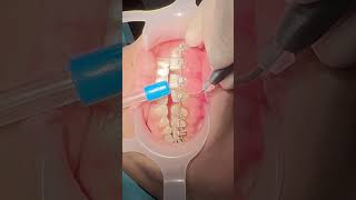 Laser gingivectomy to treat the swelled gum during bracestreatment and to correct the gummysmile [upl. by Farlay]