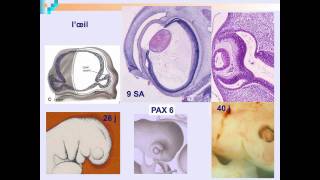 Embryofoetopathie alcoolique  Dr AnneLise DELEZOIDE partie 3 [upl. by Nnaycart]