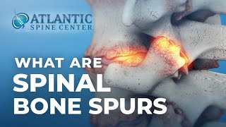 What Are Spinal Bone Spurs  Spinal Osteophytes [upl. by Yenitirb]