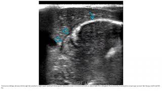 Pyloric Atresia Imaging [upl. by Segal]