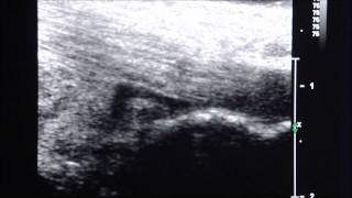 UltrasoundGuided Injection of Retrocalcaneal Bursitis [upl. by Saffier]