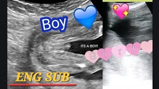 How to tell gender of Twins on ultrasound Twins Gender reveal near me  Twins heartbeat ❤️ scan [upl. by Deacon226]