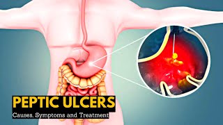 Peptic Ulcers Causes Signs and Symptoms Diagnosis and Treatment [upl. by Shandeigh365]