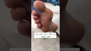 pedicure treatment men health feet clinic podologia [upl. by Nagiam]