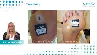 Optimizing Diabetic Foot Ulcer Treatment NATROX® O₂ Topical Oxygen Wound Therapy A UK Case Study [upl. by Alicsirp]