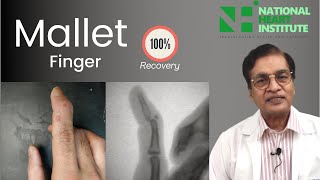 Mallet Finger Treatment In Hindi Dr Karoon Agrawal [upl. by Fredkin]