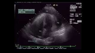 Pericardial Effusion with RA Collapse [upl. by Einnim564]