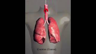 Lung SoundsNormal and AbnormalCracklesWheeze StridorRonchiOn Respiratory Auscultation Sound [upl. by Ahcarb174]