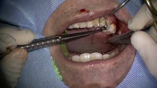 241021 Straumann RN amp WN placement in posterior mandible 1 [upl. by Mckay]