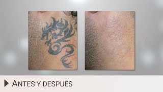 Eliminar tatuajes con láser  Antes y después [upl. by Anoiuq]