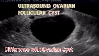 TVS Ultrasound Ovarian Follicular Cyst  Difference with Ovarian Cyst  is This Serious [upl. by Nnaasil]