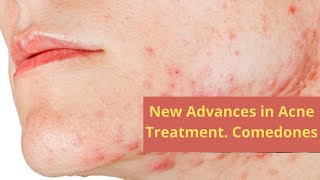 New Advances in Acne Treatment Comedones [upl. by Nazar129]