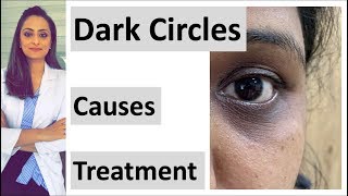 How to get rid of Dark circles  causes amp treatment  creams peels lasers fillers home remedies [upl. by Aicenek]