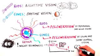 White Board Retinitis Pigmentosa RP [upl. by Raama]