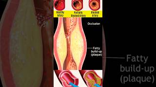 Atherosclerosis  shorts medical disease trending nursingking nursing mbbs [upl. by Karame391]