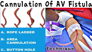 How to Cannulate fistula  Types of AV Fistula Cannulation [upl. by Buckley391]