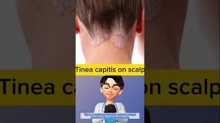 Whats wrong with scalp fungal infection  Doctor explains tinea capitis idoctor [upl. by Lebna]