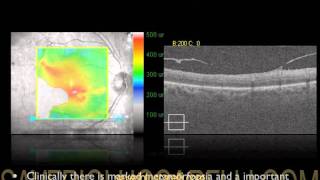 OCT IN EPIRETINAL DISEASE LE MEMBRANE EPIRETINICHE STUDIATE CON OCT MACULARE [upl. by Hillari]