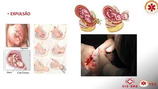 2° parte da Videoaula sobre Urgências Obstétricas [upl. by Notnerb]