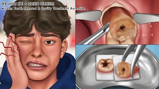 ASMR 매복 사랑니 제거 amp 충치치료 풀버전  치아미백  Wisdom Tooth amp Cavity Treatment Animation [upl. by Thetos]