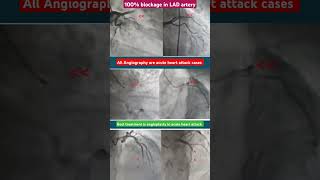 100 blockage in LAD Artery l coronary angiographyएंजियोग्राफी shorts [upl. by Kihtrak412]