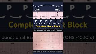 Third Degree Atrioventricular Block ECG Junctional Escape Rhythm [upl. by Illehs302]