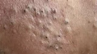 Removal of BLACKHEADS and WHITEHEADS  Acne Treatment [upl. by Nessie]