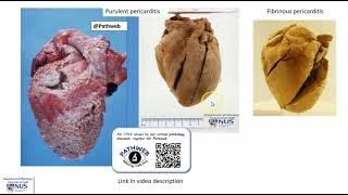 Heart Purulent pericarditis Gross pathology [upl. by Sylvanus]