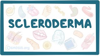 Scleroderma  an Osmosis Preview [upl. by Nonah]