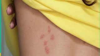 quotUnveiling the Hidden Truth Shocking Facts About Bed Bug Bites Revealedquot [upl. by Ettenawtna]