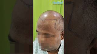 Witness the Magic Norwood VII Hair Transplant Results in Pune Revealed FUE Hair Transplant Results [upl. by Issej]