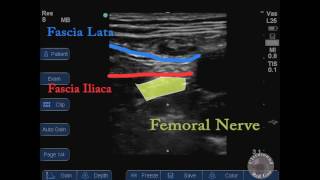 femoral nerve block with labels [upl. by Ebag158]