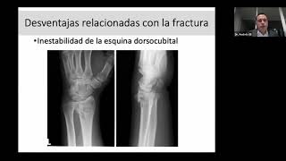 Webinar Actualización en fracturas del Radio Distal [upl. by Atinaujnas]