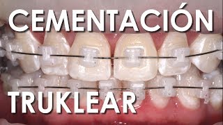 CEMENTACIÓN BRACKETS DE AUTOLIGADO CERÁMICOS  Ventajas y Desventajas [upl. by Moazami970]