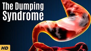 The Dumping Syndrome Everything You Need To Know [upl. by Ellord563]