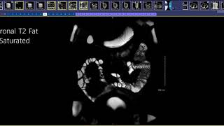 How to read an MR Enterography [upl. by Neelyahs]