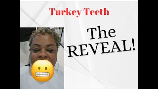 THE REVEAL  African American Woman Getting TURKEY TEETH [upl. by Pandich]