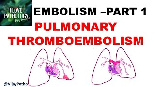 EMBOLISM Part 1 Pulmonary amp Systemic thromboembolism [upl. by Adhern]